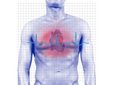 Stress et infarctus