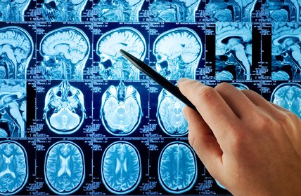 Le stress toxique pour la substance grise de notre cerveau…