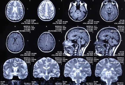 Le stress aigu modifie le mode de fonctionnement de notre cerveau..