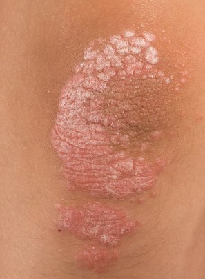 Le stress favoriserait la survenue de maladies auto-immunes