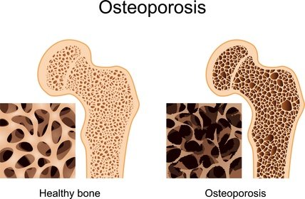 Stress et ostéoporose…